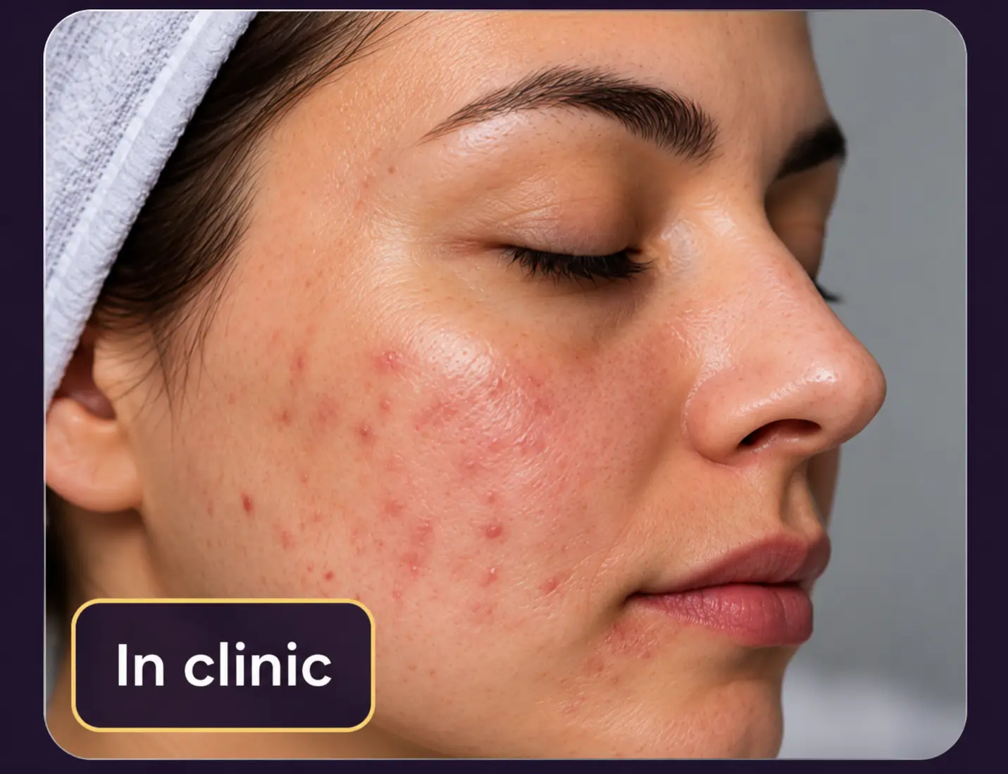Before photo taken in clinic, side profile of a patient with acne and redness on the cheek