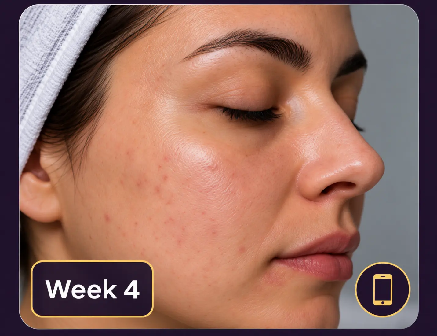 Week 4 follow-up photo uploaded remotely by the patient, showing clearer skin with fading marks